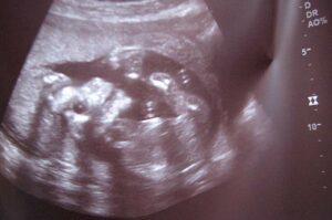 Fetus womb