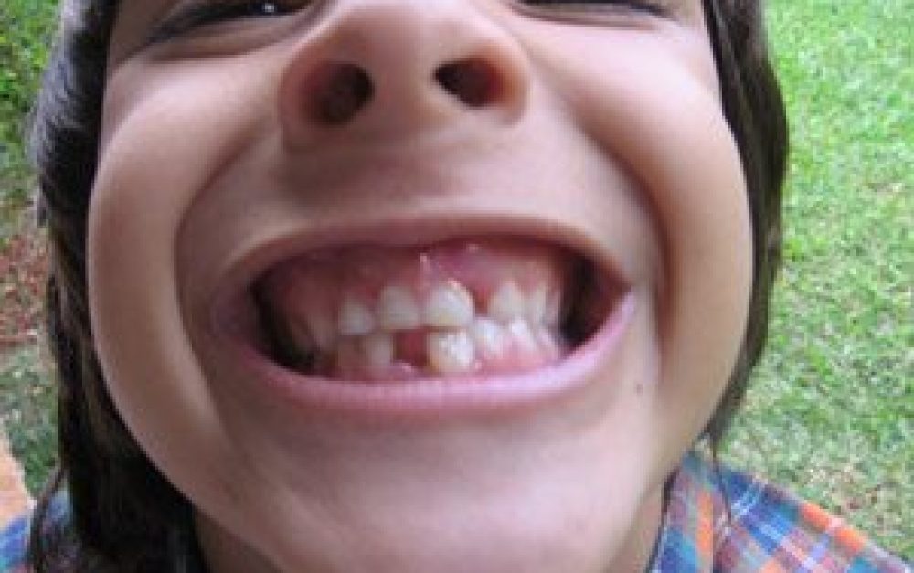 kid-child-teeth